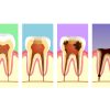 歯槽骨の<span>再生</span>は自然に起こる？治療の期間や費用は？保険は効く？