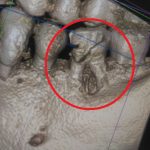 【CT画像あり】虫歯の<span>神経を抜いた後</span>に歯槽骨が溶けるという体験をしました
