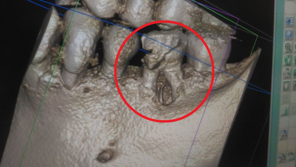 虫歯の神経を抜いた20年後に歯槽骨が吸収