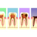 歯槽骨の再生は自然に起こる？治療の期間や費用は？保険は効く？